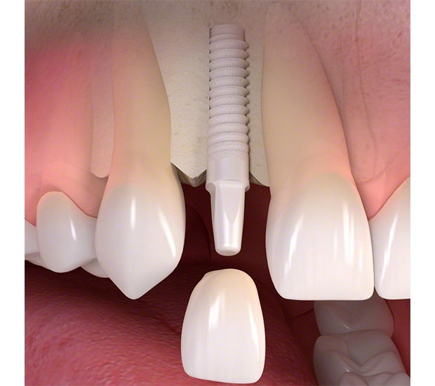 Williamsville Dental Implants